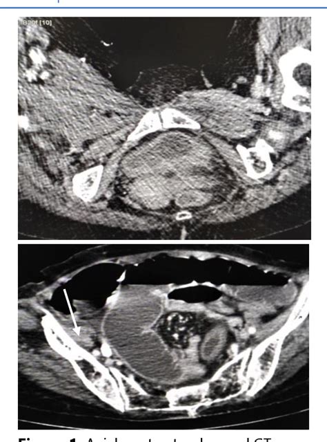 Figure 1 from Obturator Hernia – a Case Report | Semantic Scholar