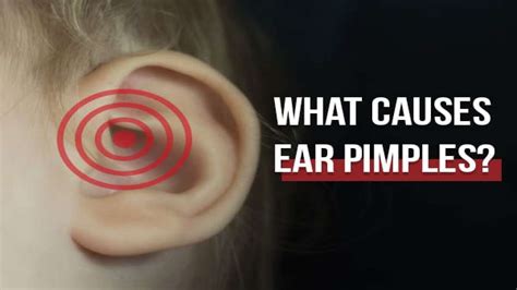 What Causes Ear Pimples And How To Treat It - Boldsky.com