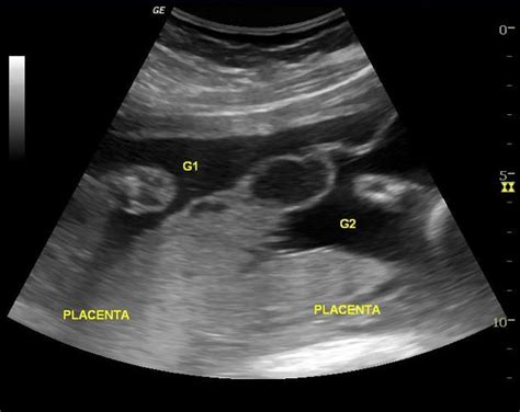 Hamburger Sign Ultrasound