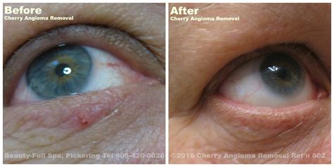 Cherry Angioma Removal Before and After | Beauty-Full Spa