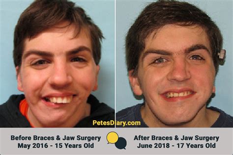 Braces Before And After Face Shape | Before And After