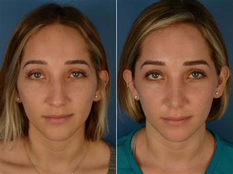 Rhinoplasty Photos | Naples, FL | Patient 14246