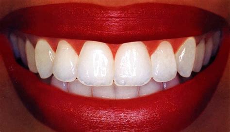 TEETH WHITENING IN YOUR PROFESSIONAL DENTAL SET UP | DENTALORG.COM