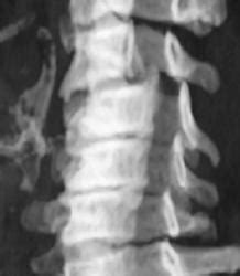 C-spine Fracture and Rotational Injury - Musculoskeletal Case Studies - CTisus CT Scanning