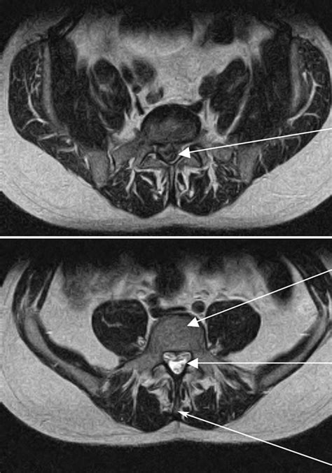 Cauda Equina Anatomy Mri