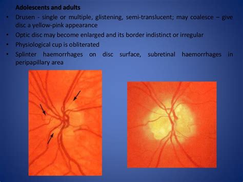 Optic disc evaluation