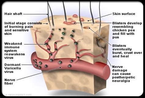 What Is Shingles? Causes, Symptoms and Treatment - HubPages