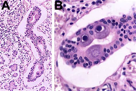 (A) Histology of parotid gland demonstrating CMV infection 100 Â , H&E ...