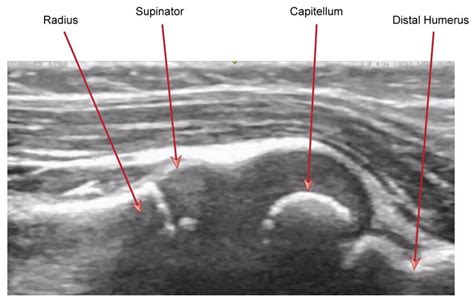 Sonographic anatomy -normal appearances. In this image the ultrasound... | Download Scientific ...