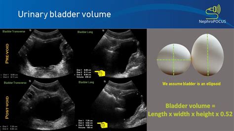 Bladder ultrasound: calculation of volume – NephroPOCUS