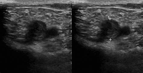 Acute Iliofemoral Deep Vein Thrombosis | Thoracic Key