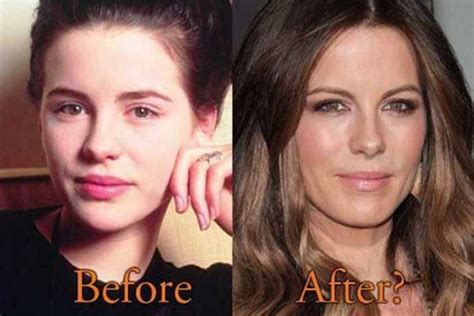 Kate Beckinsale Plastic Surgery: Botox, Boob Job, Nose job