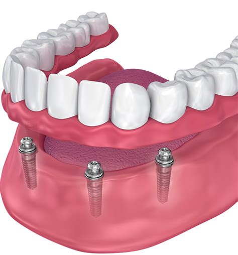 Implant-Supported Dentures - Virginia Beach, VA - Dr. Scott Parr