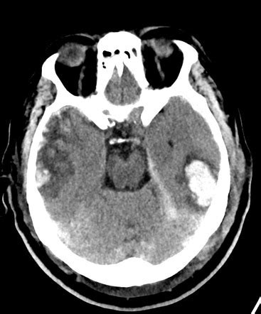 Traumatic brain injury | Radiology Reference Article | Radiopaedia.org