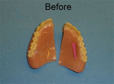 Dentures Repairs - Academy Denture Clinic