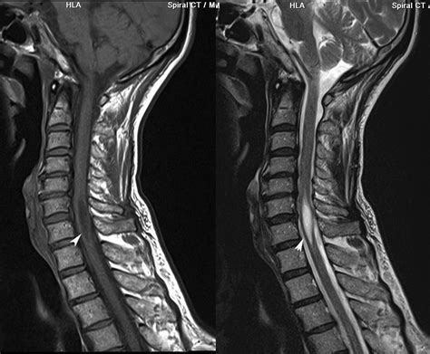 Radiodiagnosis - Imaging is Amazing-Interesting cases: Syrinx - MRI