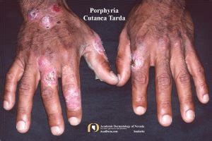 Porphyria Cutanea Tarda (PCT): A Photosensitive Disorder... - Academic ...