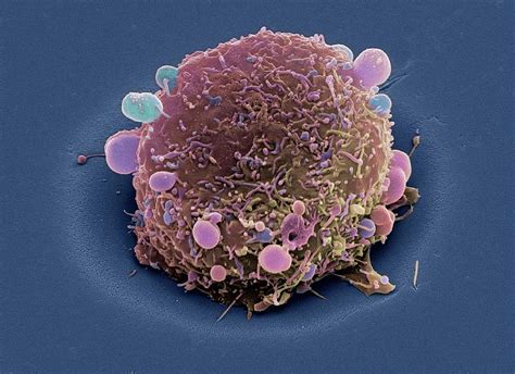 Lung Cancer Cell Photograph by Steve Gschmeissner/science Photo Library ...