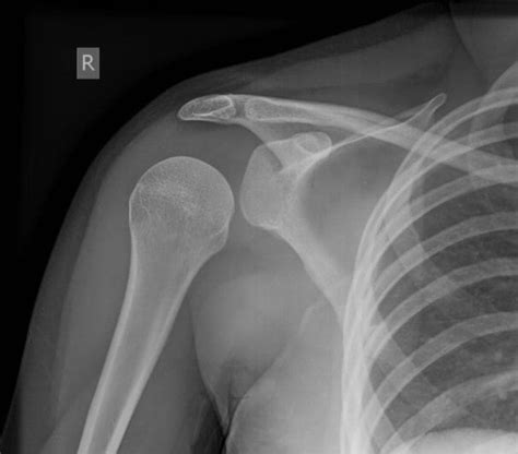 Shoulder Dystocia Xray