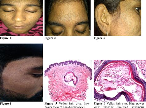 Figure 1 from A rare case of Eruptive Vellus Hair Cysts: facial variant | Semantic Scholar