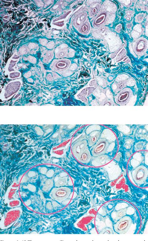 Figure 1 from The Arrector Pili Muscle and the Follicular Unit of the ...