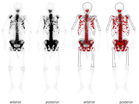 Bone scintigraphy at the time of diagnosis showing high volume multiple ...