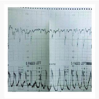 Tachysystole and uterine hyperstimulation. | Download Scientific Diagram