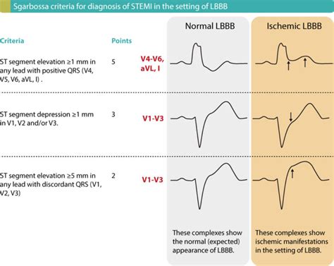 STEMI (ST Elevation Myocardial Infarction): diagnosis, criteria, ECG ...