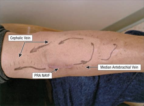 Arm Fistula Anatomy at Antonia Randall blog