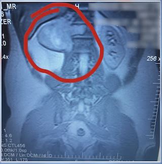 UTSW removes runner’s melon-sized spine tumor with minimally invasive ...