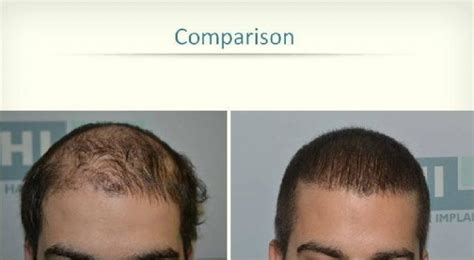 DHI hair transplant review images – Hair Restoration News Worldwide