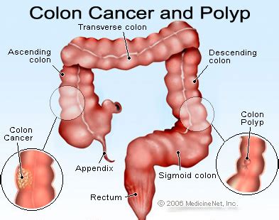 Colon Cancer - Sign and Symptoms - Your Health