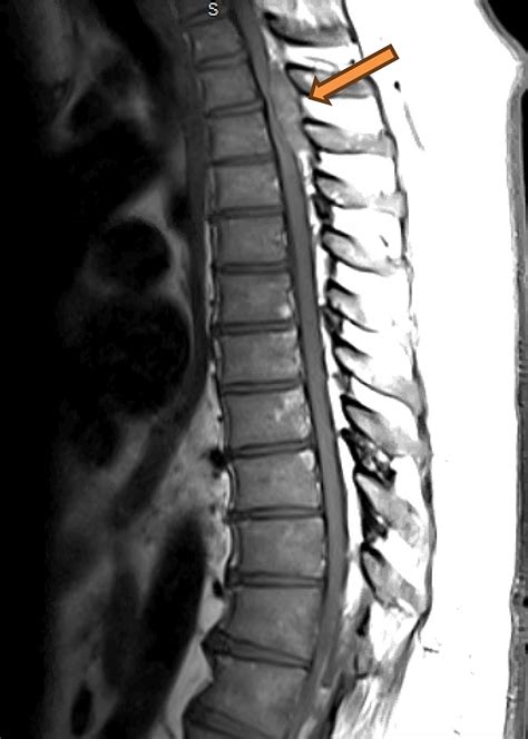 A Case of Thoracic Epidural Angiolipoma Causing Severe Spinal Cord Compression With Neurologic ...