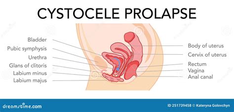 Prolapse Cystocele Female Reproductive System Uterus With Inscriptions Text. Side View Human ...