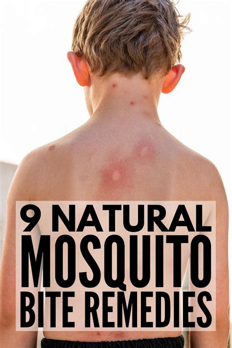 Stop The Itch! 9 Natural Mosquito Bite Remedies that Work