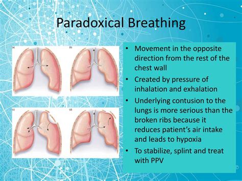 PPT - Chest Trauma PowerPoint Presentation, free download - ID:5319182