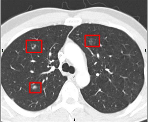 Lung Ct Scan Without Contrast