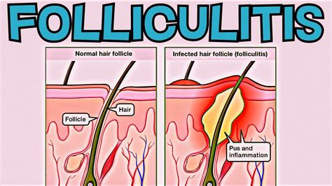 What is Folliculitis? Folliculitis EXPLAINED in 2 Minutes - Signs, Symptoms, Cause, Treatment ...