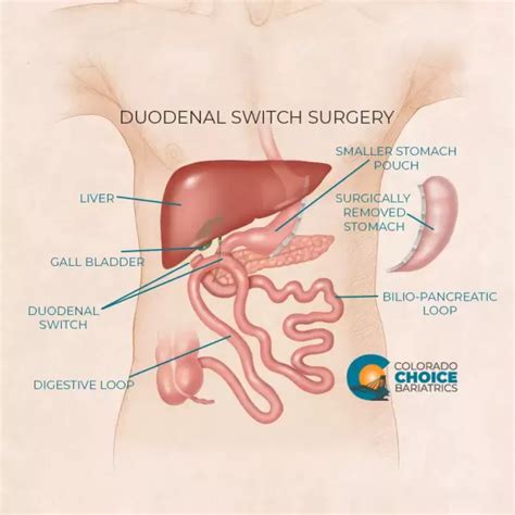 Duodenal Switch Surgery | Colorado Choice Bariatrics