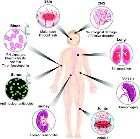 Treatment of Systemic Lupus Erythematosus - Rxharun