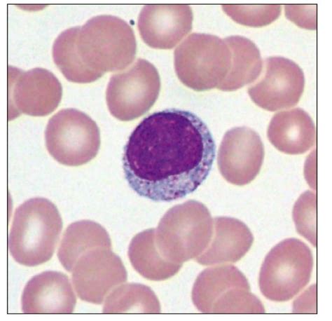 Granular Lymphocyte with Azurophilic Cytoplasmic Granules