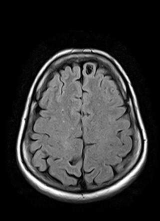 Neuroglial cyst | Image | Radiopaedia.org