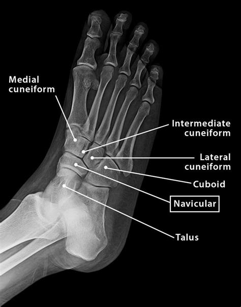 Navicular Bone - Location, Anatomy, & Labeled Diagram