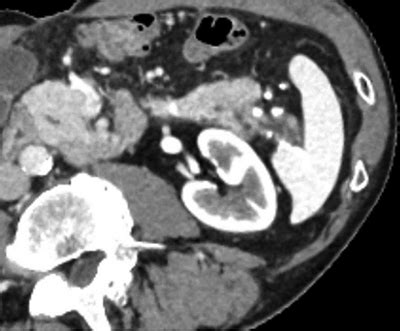 A Rare Case of Wirsung Duct Duplication with Chronic Pancreatitis ...