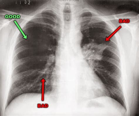 Health and Wellness: Pneumonia (Pulmonya)