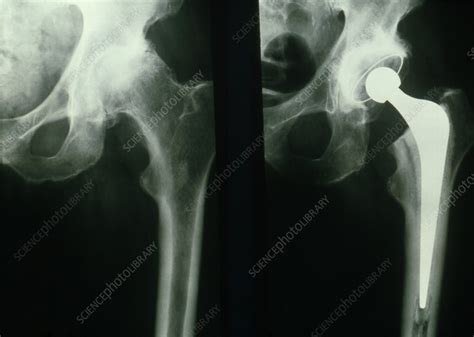 X-rays before & after hip replacement surgery - Stock Image - M600/0143 - Science Photo Library