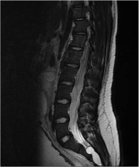 Sacral tarlov cyst, 1.4cm (MRI T2). | Download Scientific Diagram