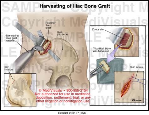 Harvesting of Iliac Bone Graft Medical Illustration Medivisuals