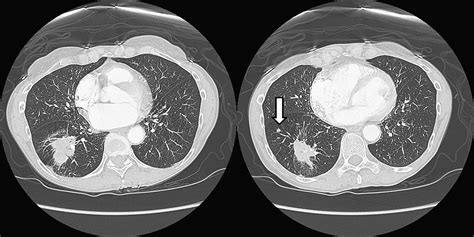 Additional Pulmonary Nodules in the Patient with Lung Cancer: Controversies and Challenges ...