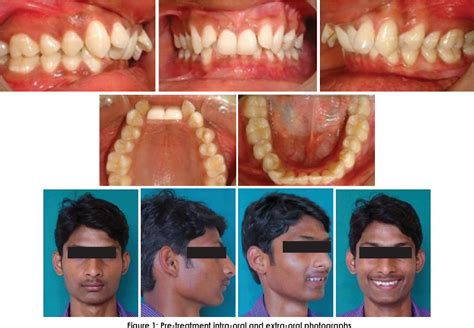 Figure 1 from Treatment of Class II Div 2 Malocclusion using PowerScope: A Case Report ...